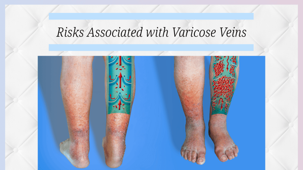 Illustration of varicose veins with annotated health risks.