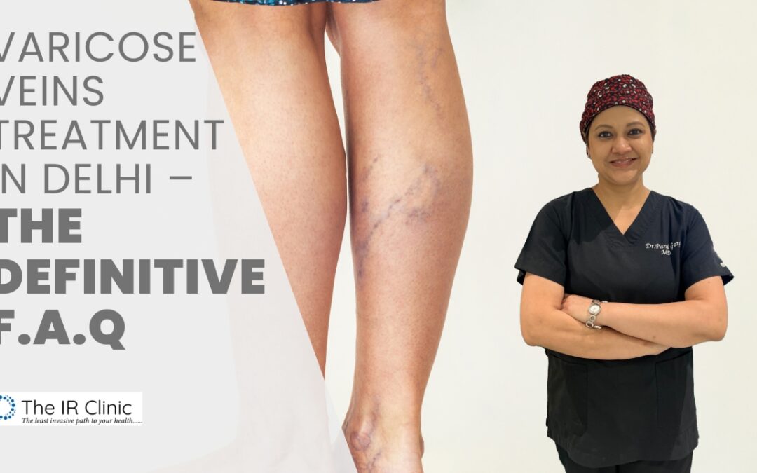 Varicose Veins Treatment in Delhi – Definitive FAQ