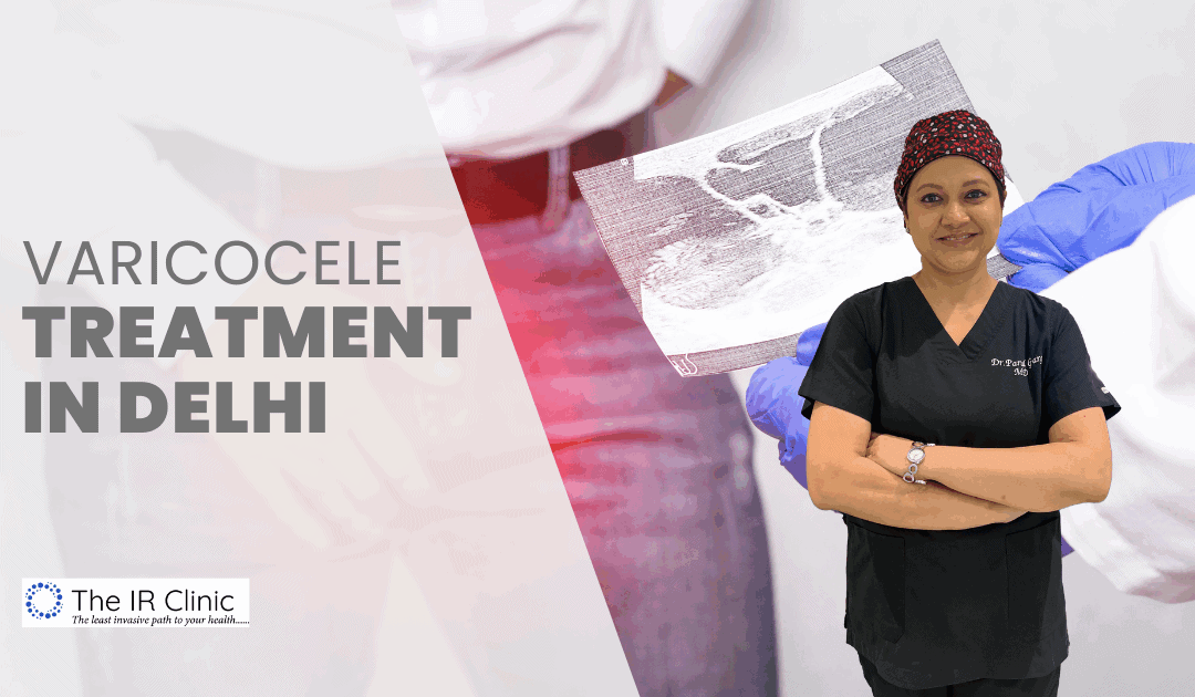 Varicocele Treatment in Delhi